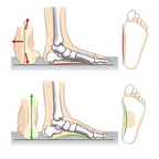 Akusoli Arch Support Bundle