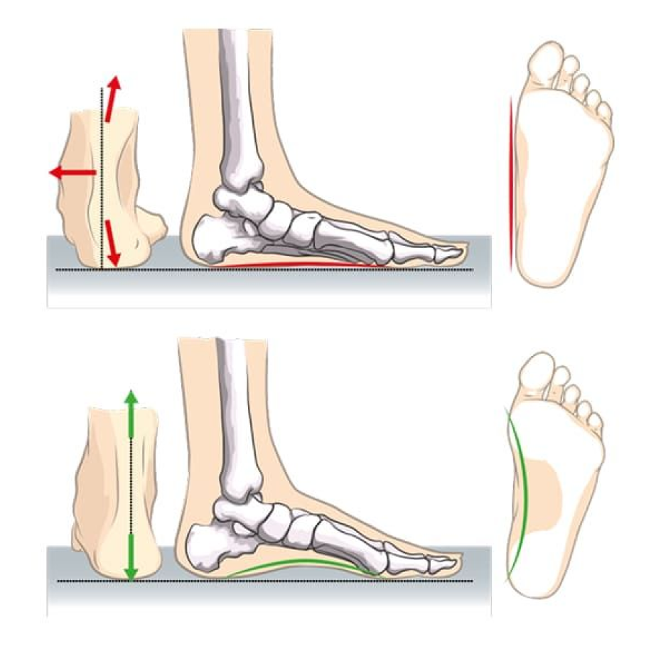 Akusoli Arch Support Bundle